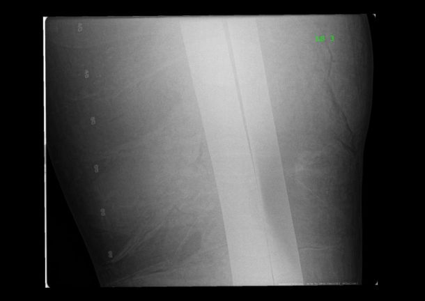 X-ray showing two metal bars inside David's left leg.