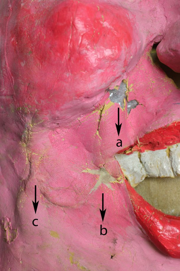 Figure 3. The brittle edges of the losses were stabilized with patches of Reemay (a), the filled with Plasticine clay (b), before being in-painted with a multi-step process to blend with the surrounding latex (c)